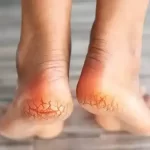 Cracked heels