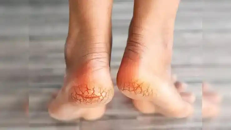 Cracked heels Cracked heels