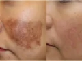Mango Spots Removal Tips
